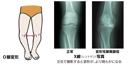 変形性膝関節症の原因と病態