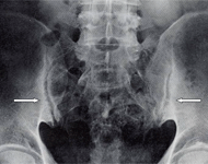 仙腸関節炎