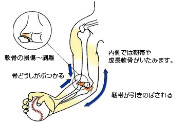 野球肘の原因と病態