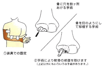 野球肘の予防と治療