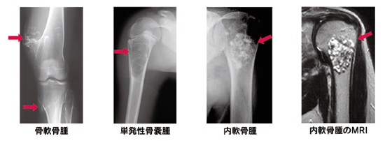 良性骨腫瘍 日本整形外科学会 症状 病気をしらべる