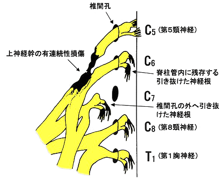 図2　腕神経叢の損傷の種類