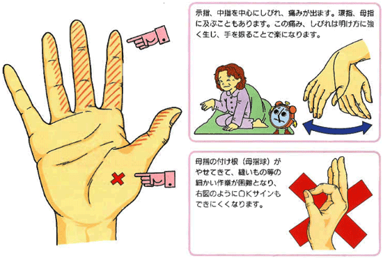 手根管症候群 日本整形外科学会 症状 病気をしらべる