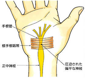 手根管症候群 日本整形外科学会 症状 病気をしらべる