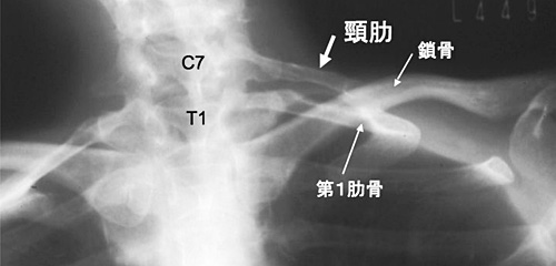 X線による頚肋の確認