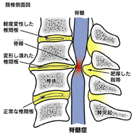 頚椎症性脊髄症 日本整形外科学会 症状 病気をしらべる