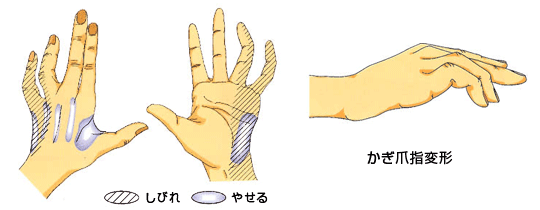 肘部管症候群の症状