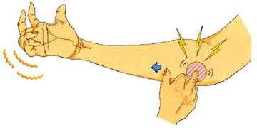 Diagnosis of cubital tunnel syndrome