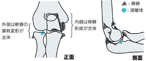 変形性肘関節症の原因と病態