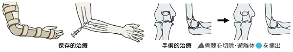 変形性肘関節症の予防と治療