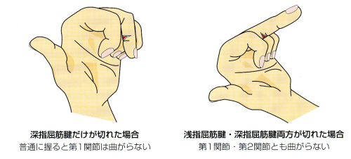 指の屈筋腱損傷 日本整形外科学会 症状 病気をしらべる