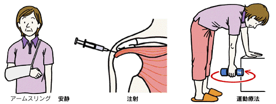 五十肩 の 治し 方 注射