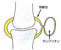 ガングリオンの病態