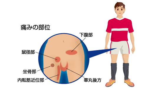 鼠径部痛症候群の症状