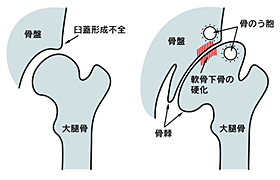 変形性股関節症