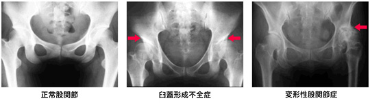 変形性股関節症のレントゲン写真