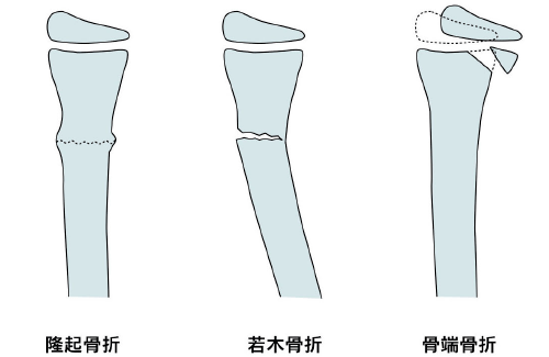 見分け 骨折 方 指 足