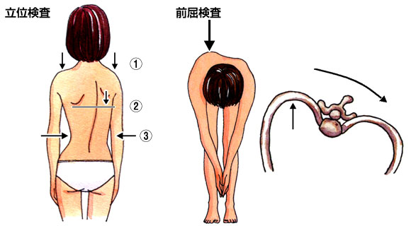 小児の脊柱側弯症 日本整形外科学会 症状 病気をしらべる