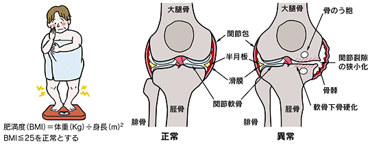 太りすぎによる変形性膝関節症の患者と、変形性膝関節症の様子