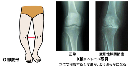 変形性膝関節症のレントゲン写真とその様子