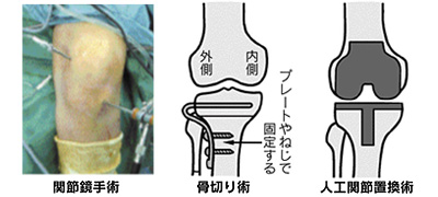 変形性膝関節症の治療