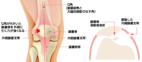 膝蓋骨脱臼の病態