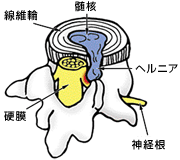 椎間板ヘルニアの病態