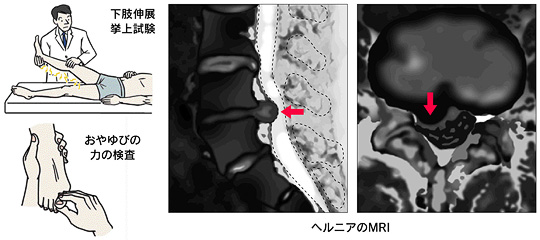 椎間板ヘルニアの診断