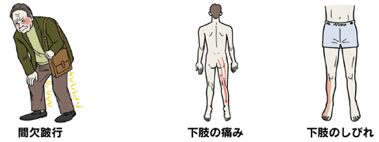 腰部 脊柱 管 狭窄 症 と は