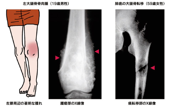 悪性骨腫瘍 日本整形外科学会 症状 病気をしらべる