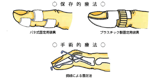 「槌指」の画像検索結果