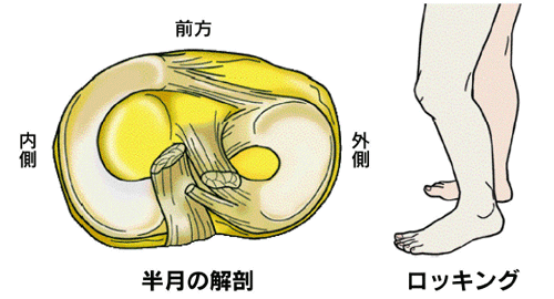 半月 板 損傷 日本整形外科学会 症状 病気をしらべる