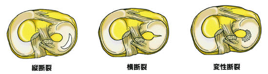 半月 板 損傷 日本整形外科学会 症状 病気をしらべる