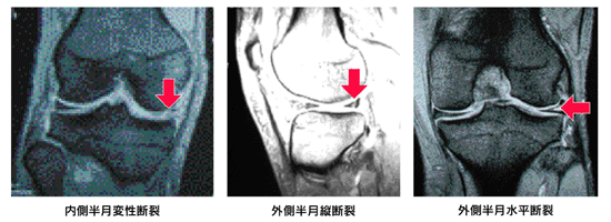 半月 板 損傷 日本整形外科学会 症状 病気をしらべる