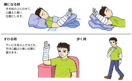 手の手術をされた方へ 日本整形外科学会 症状 病気をしらべる