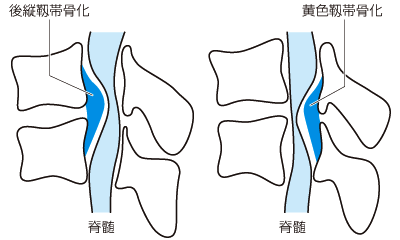 後縦靭帯骨化症と黄色靭帯骨化症