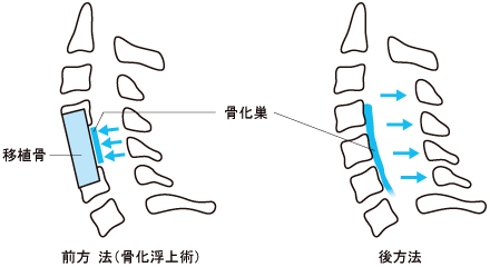 骨 化 症 十字 靭帯 後