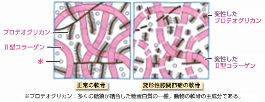 正常と変形性関節症の軟骨の模式図