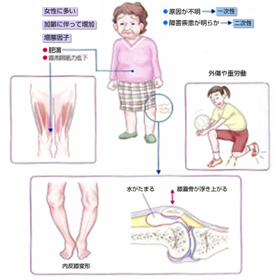 変形性関節症の病因・増悪因子