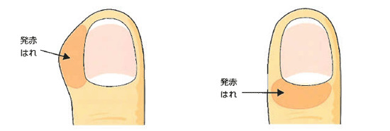 爪周囲炎 日本整形外科学会 症状 病気をしらべる