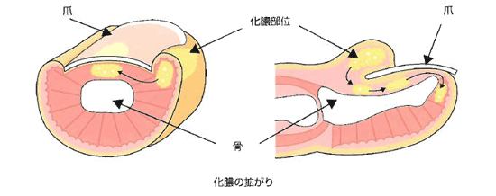 爪周囲炎 日本整形外科学会 症状 病気をしらべる