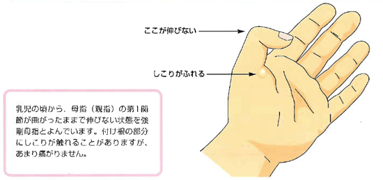 付け根 手のひら 痛い の 親指 ふくらみ