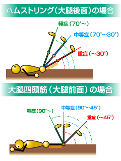 何 治る まで 日 肉離れ 軽い