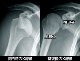 反復性肩関節脱臼 日本整形外科学会 症状 病気をしらべる