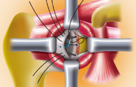 反復性肩関節脱臼の治療