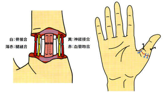 切断された指の再接着 日本整形外科学会 症状 病気をしらべる