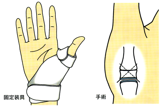 親指 の 付け根 が 痛い 腱鞘炎