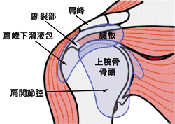 腱 板 損傷