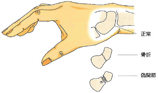 舟状骨骨折 日本整形外科学会 症状 病気をしらべる