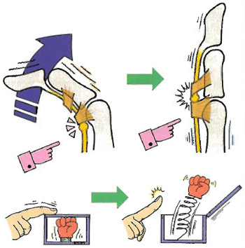 ばね指 弾発指 日本整形外科学会 症状 病気をしらべる